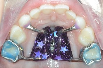 Аппарат Марко Росса — несъемные пластинки в Atribeaute Kids