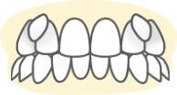 Неправильное положение клыков